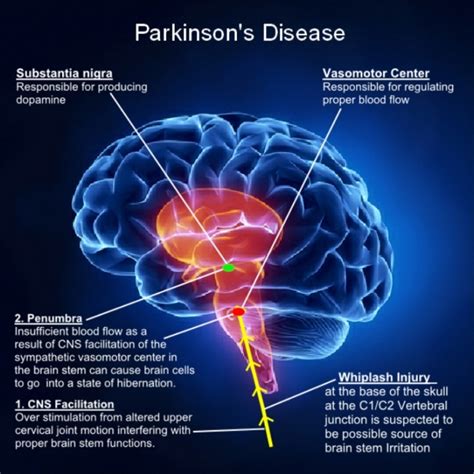 parkinson disease affects what part of brain